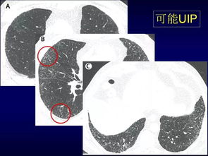 特发性肺纤维化的CT诊断进展