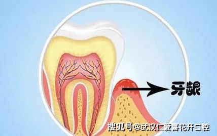 什么是牙槽骨 牙槽骨吸收的症状有哪些
