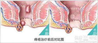 长痔疮怎么办呢