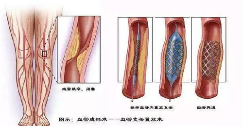 血管堵塞,医生是用这个方法恢复通畅的,3D动画展示整个过程