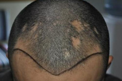 植发对身体健康有影响吗 植发对头皮有伤害吗