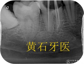 为什么不建议桩冠修复(桩冠修复不适于)