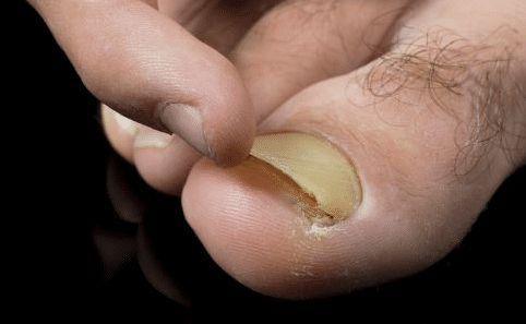 灰指甲5种常见类型及专用药了解吗 皮肤医生列出详细用药攻略