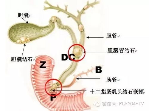 胆囊结石必须要摘除胆囊吗