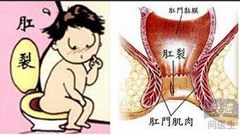 肛裂形成的主要原因有哪些