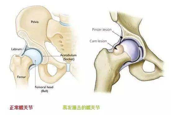 髋关节撞击Hip impingement 顺德康复