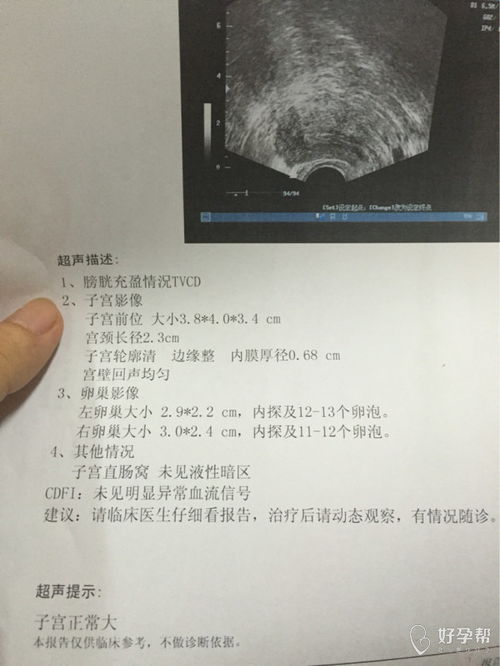 您好 请问我这种情况是多囊吗