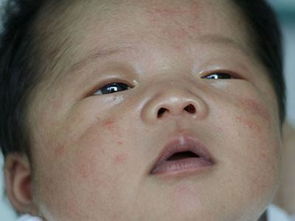 婴儿湿疹症状(婴儿湿疹症状有哪些)
