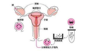 备孕大半年后,决定做人工授精了,具体的流程是怎样的呢