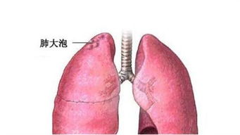 肺部疾病气胸能治愈吗