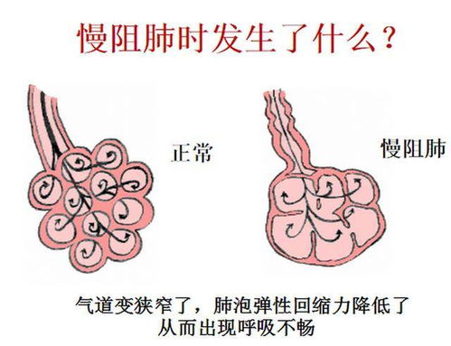 肺病的种类，常见肺病种类有哪些