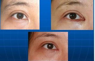 双眼皮要吃几天消炎药,做过双眼皮手术需要吃多久消炎药
