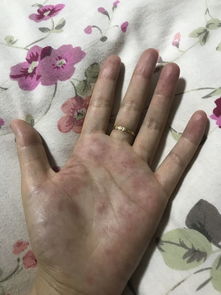 手掌金星丘总是疼,手相能看出哪些疾病