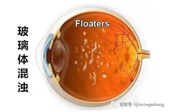 招飞体检眼科常见异常 玻璃体动脉残留