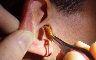 耳屎 不同形状代表什么 耳屎堵在外耳道正常吗 
