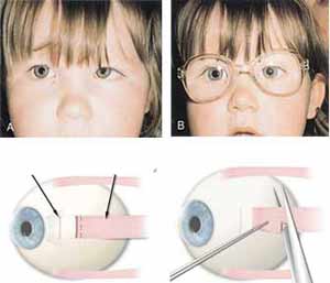 13岁孩子右眼轻微斜视可以做手术矫正吗(13岁眼睛斜视能矫正吗)