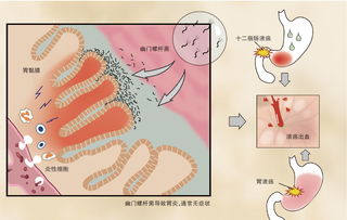 胃癌的元凶 中国感染率超50 的幽门螺旋杆菌 检测5折特惠
