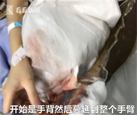 深圳女子市场闲逛好奇观蛇被咬 手臂黑肿差点要截肢 