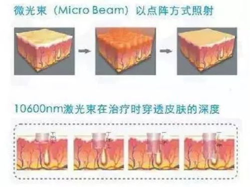 不能忍,满脸痘坑怎么淡定做 佛系青年 一招告别月球表面,肌肤恢复细 嫩 滑 