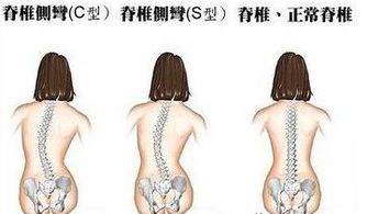 脊柱侧弯具体有哪些危害 