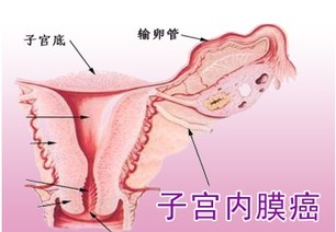 孕激素治疗子宫内膜癌