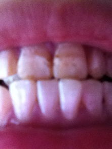 牙齿下有白色的是什么东西