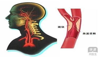 中医养生对主动脉硬化有哪些治疗方法？