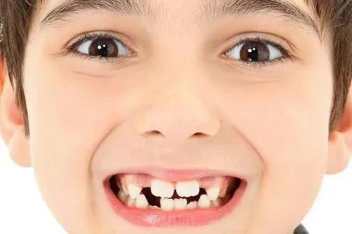 儿童替牙期的烦恼 门牙变成大板牙是怎么回事