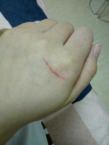 今天被家养的猫抓伤了,买回来五天了,两个月的幼猫,看伤口这样,要打吗