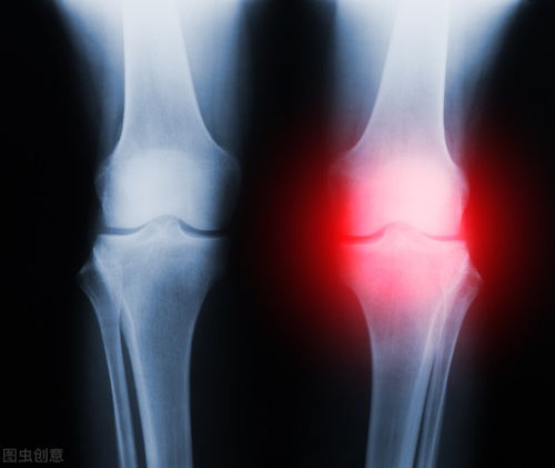 膝关节有响声是怎么回事 医生总结了2种原因,第1种无需治疗