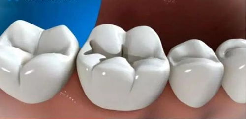 补牙属于医保报销吗