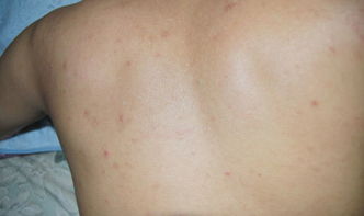 背上长红疙瘩,很痒,是属于什么皮肤病,该怎样治疗 