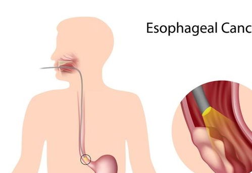 消化科专家 食道癌不痒不痛,若出现这种迹象,是食道在向你求救