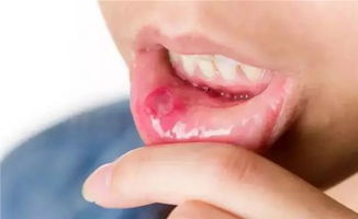 口苦腹胀口腔溃疡是什么原因,腹胀口苦有便秘口腔溃疡什么原因引起的