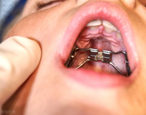 牙齿拥挤可以不进行拔牙矫正吗 试试这两种方案