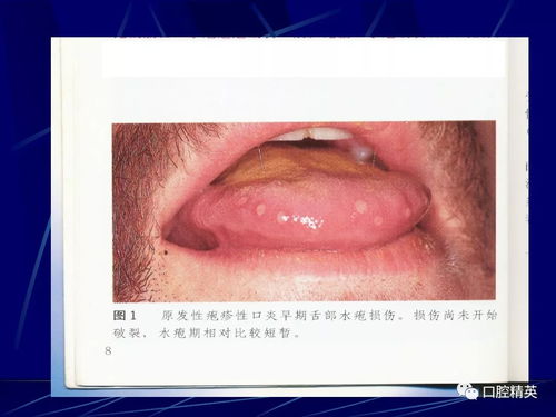 常见的口腔黏膜病 