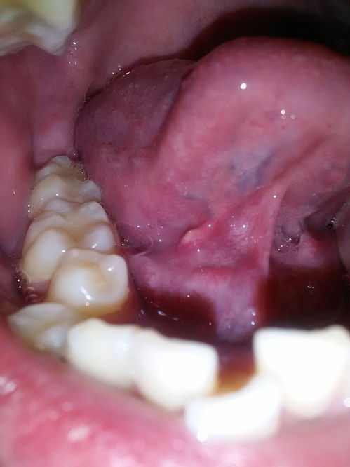 舌下腺管口图片图片
