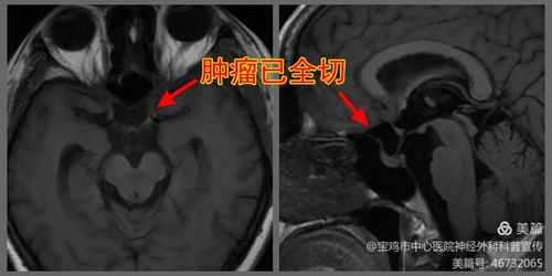 肚子里怀着孩子,脑袋里长着瘤子,怎么办 宝鸡市中心医院给出了可喜的答案