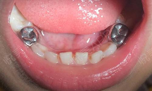 乳牙龋坏需要治疗吗
