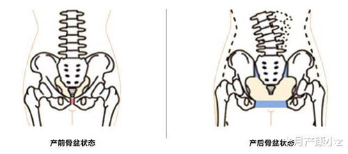 导致骨盆错位有以下原因,你有没有中招