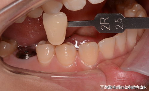 缺牙 坏牙,根管治疗等5大误区