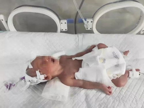 一公斤重的早产宝宝命悬一线,西盟县人民医院延续奇迹