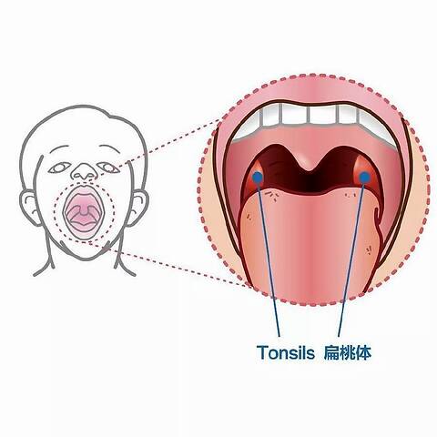 扁桃体123度图片图片