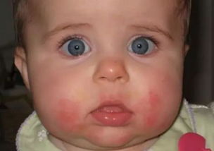 婴儿口周起湿疹,宝宝口周湿疹如何治疗呢?