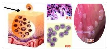 老公有尖锐湿疣快二年了今天我去医院查出有高危型人乳头状瘤病毒感染是我老公感染的我？还是我传染的我老公