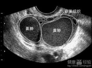 巧克力囊肿发病特点包括哪几方面