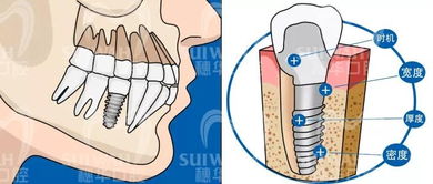 缺牙修复方式大PK,让你一目了然
