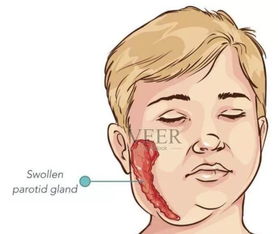 守护儿童安全之疾病篇 认识腮腺炎