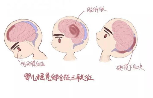 当心 摇晃 式哄娃暗藏的危险你知道吗