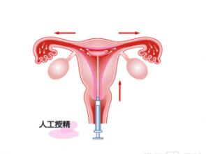 人工受孕成功几率到底有多高 